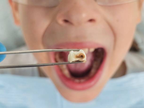 Best Emergency Wisdom Teeth Removal in Lake Lifornia, CA